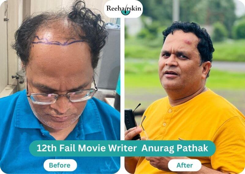 Hair Transplant result 12th fail movie writer anurag pathak